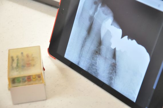 歯のレントゲン